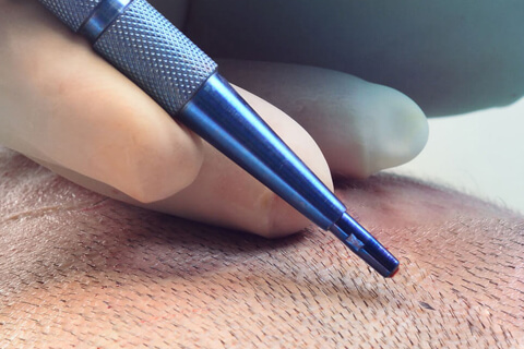 Sapphire FUE Technique