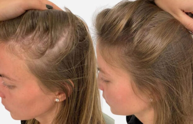 CAN A HAIR TRANSPLANT BE DONE IN WOMEN?