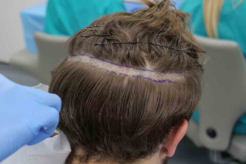 No-Shave Hair Transplant