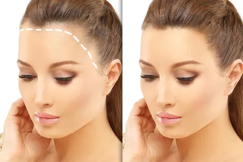 Female Hair Transplant