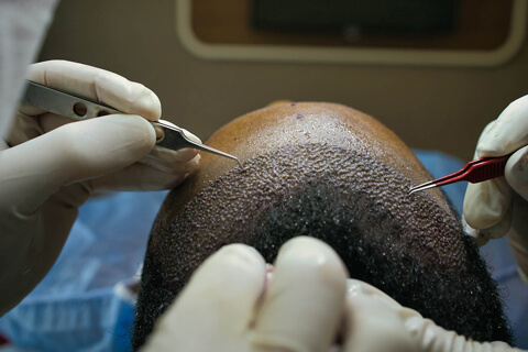 Hair Transplant